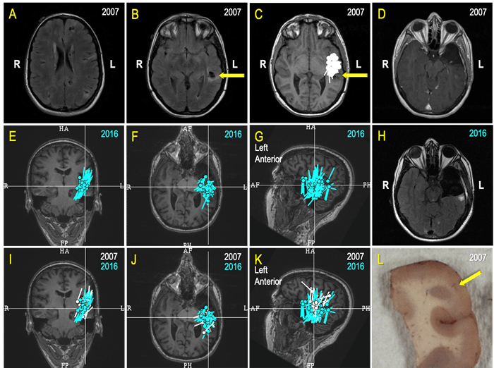 brain scans of a woman who underwent MEG that identified her seizure focus