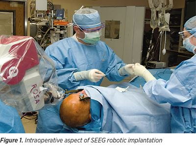  Intraoperative aspect of SEEG robotic implantation