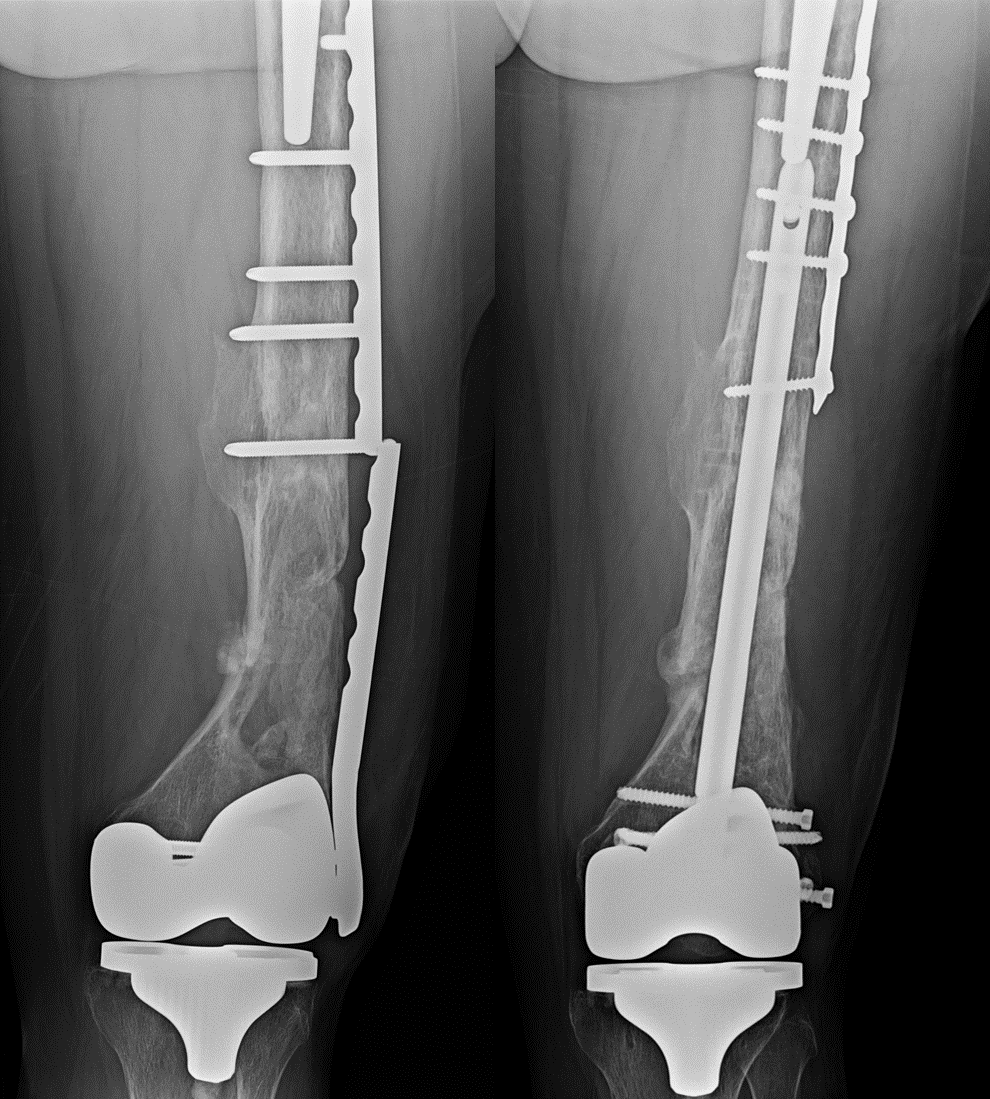 Medicina | Free Full-Text | Intertrochanteric Femoral Fractures: A  Comparison of Clinical and Radiographic Results with the Proximal Femoral  Intramedullary Nail (PROFIN), the Anti-Rotation Proximal Femoral Nail  (A-PFN), and the InterTAN Nail