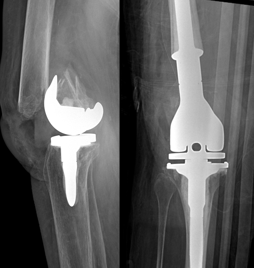 Intertrochanteric fracture left femur (fracture thigh's bone). It was  operated and insert intramedullary nail. Stock Photo by ©stockdevil_666  61373215