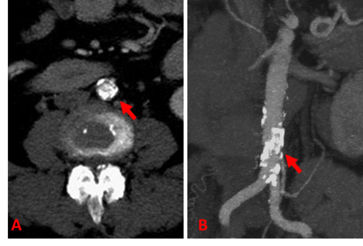 Aortic Endart Fig 1 AB