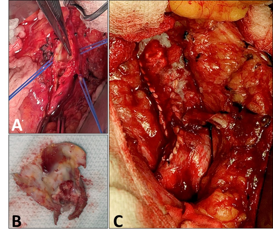 Aortic Endart Fig 2 ABC