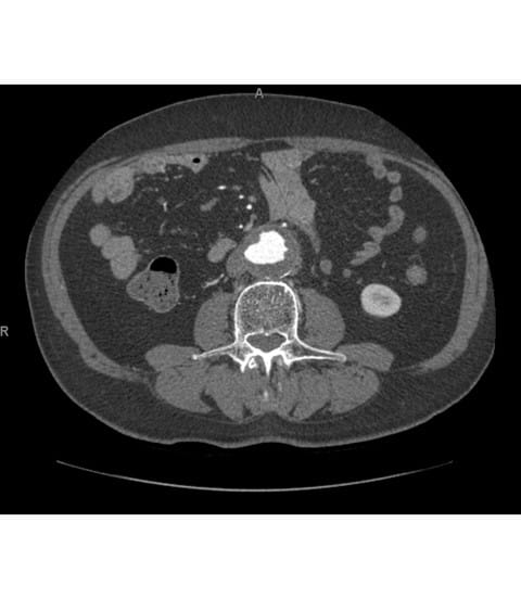 Bilateral IBE Fig 1 Vascular Rounds Summer 2019