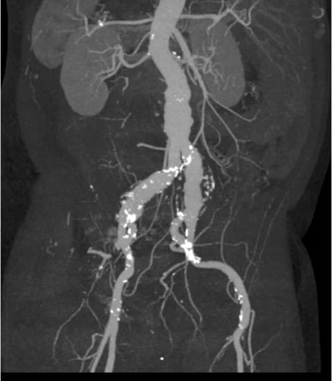 Bilateral IBE Fig 3 Vascular Rounds Summer 2019 