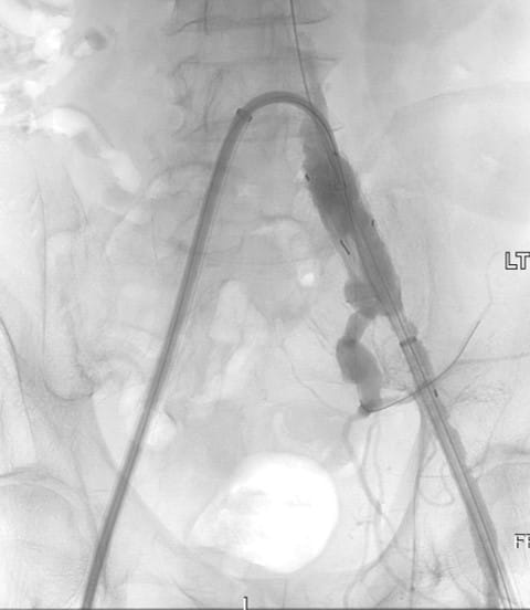 Bilateral IBE Fig 4 Vascular Rounds Summer 2019