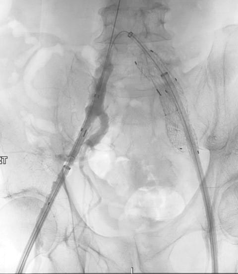 Bilateral IBE Fig 5 Vascular Rounds Summer 2019
