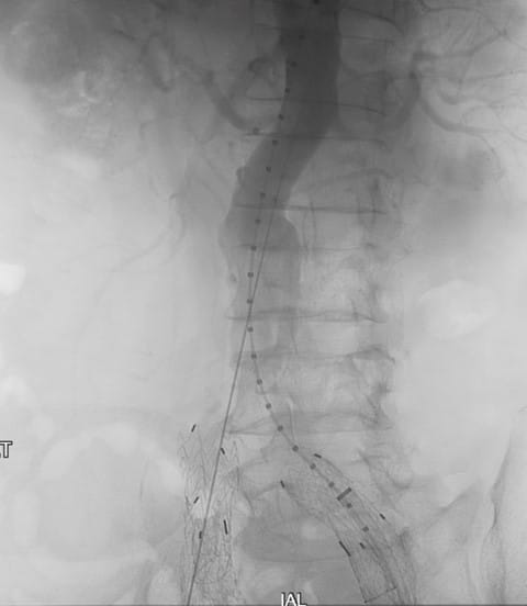 Bilateral IBE Fig 6 Vascular Rounds Summer 2019