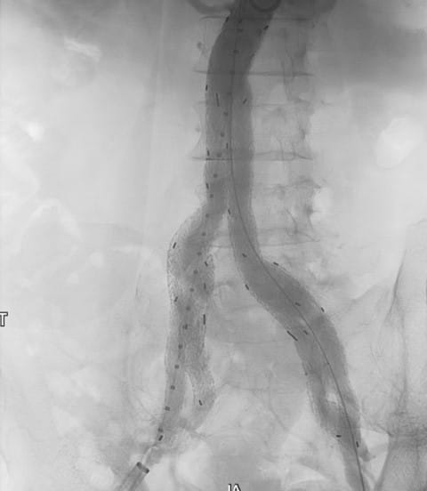 Bilateral IBE Fig 7 Vascular Rounds Summer 2019
