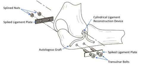 The plates are secured to the proximal ulna with the nuts and bolts as shown in this schematic.