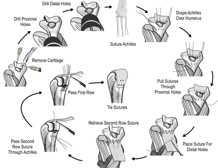 Interposition arthroplasty is performed by resurfacing the distal humerus with an Achilles allograft.
