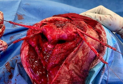 The elbow is dislocated, and the distal humerus has been resurfaced with the Achilles autograft and the ligament reconstruction limbs are being pulled into the distal humerus.