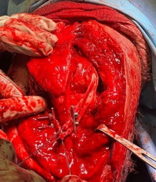 The elbow is reduced, and the grafts have been placed under the aggressively teethed plates and will be tensioned shortly. Once tensioned, the nuts and bolts are tightened to lock in the tension within the graft limbs.