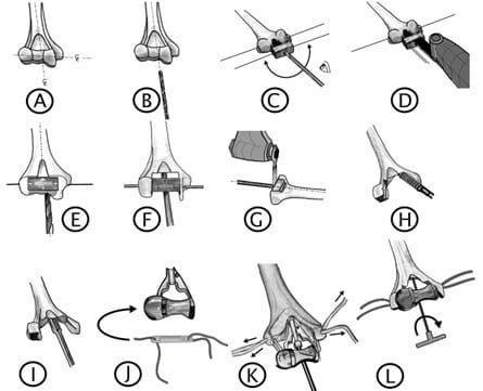 Hemiarthroplasty implantation follows a process of establishing anatomic landmarks and then drilling, cutting and broaching the bone to create a cavity for the implant. A screw is then used to seat the implant while the ligament reconstruction limbs are located at the point of isometry for later attachment to the olecranon.