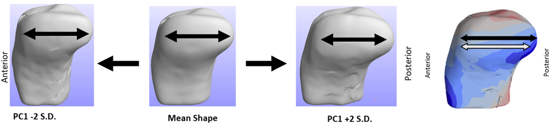 3D shape modeling of ACL injury