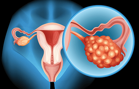 Image of uterus. 