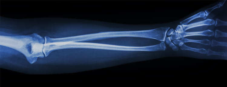 UPMC Physician Resources Arm Bones X Ray Orthopaedics