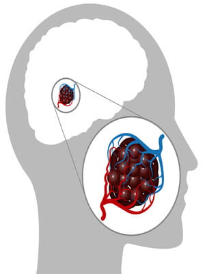 Cerebral Cavernous Malformation diagram.