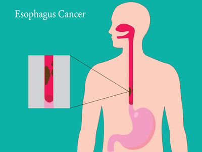 Esophageal cancer diagram
