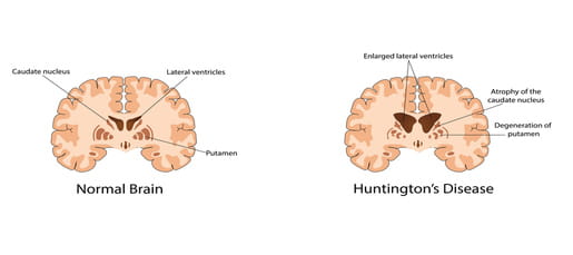 Image comparing Huntingdon's Diseased brain to a normal one.