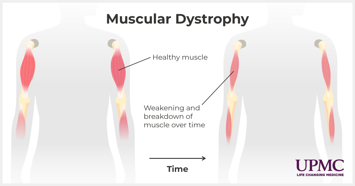 Muscular dystrophy medical diagram.