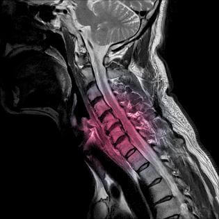 Myelopathy