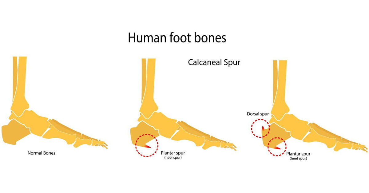 Diagram of a bone spur.