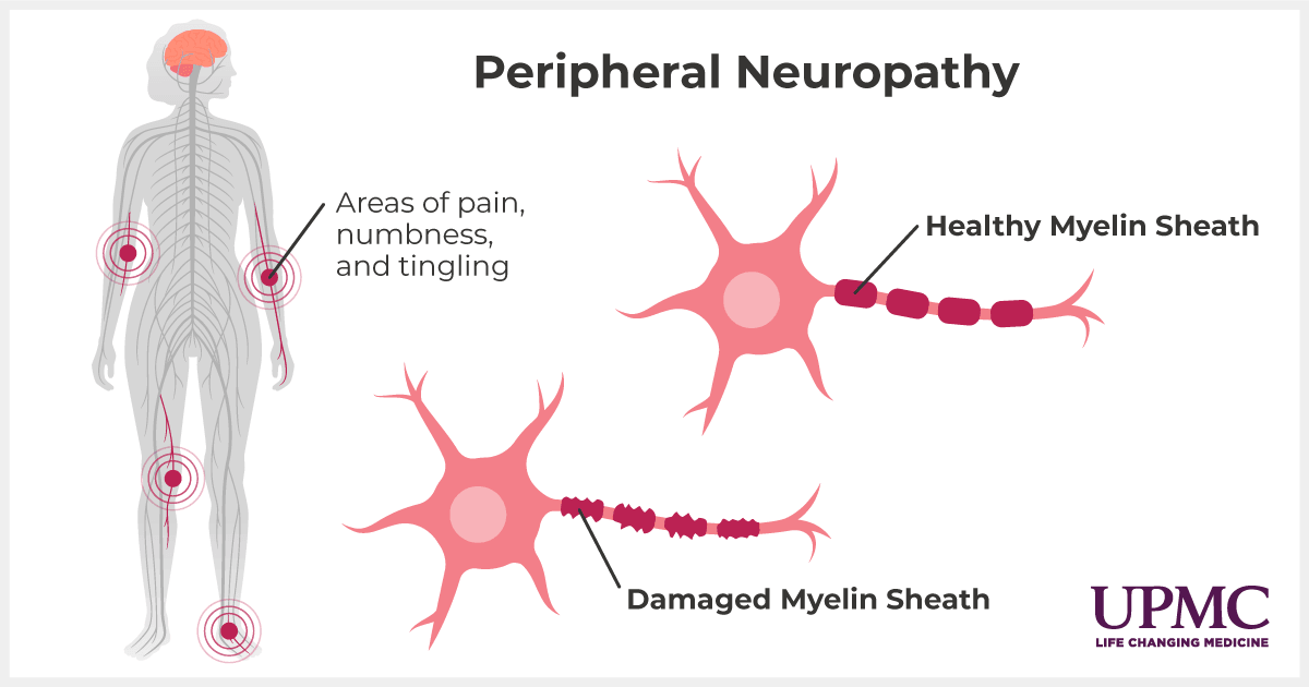 Peripheral neuropathy diagram.