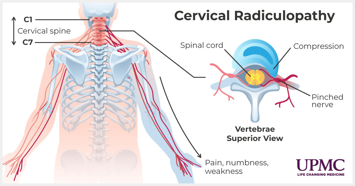 Cervical radiculopathy medical diagram.