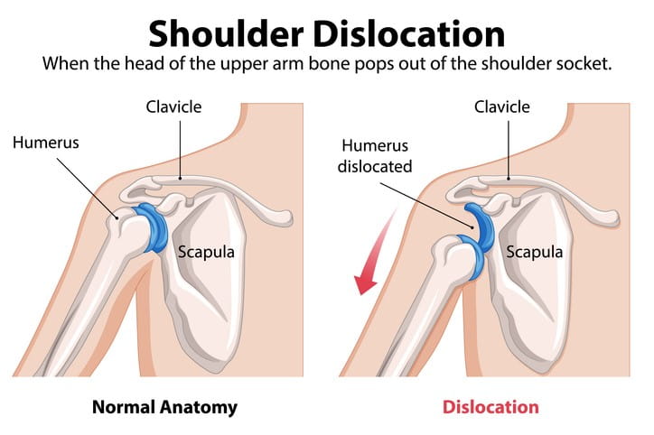 Image of shoulder dislocation.