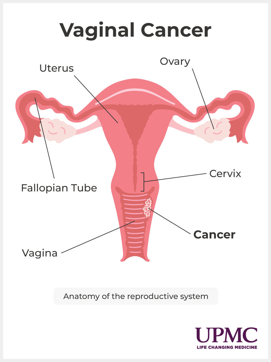 Diagram of vaginal cancer.