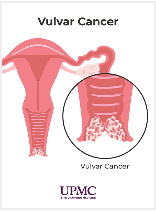Vulvar cancer diagram.