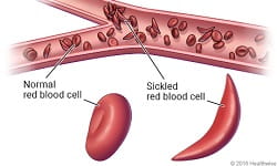 Sickle Cell feature