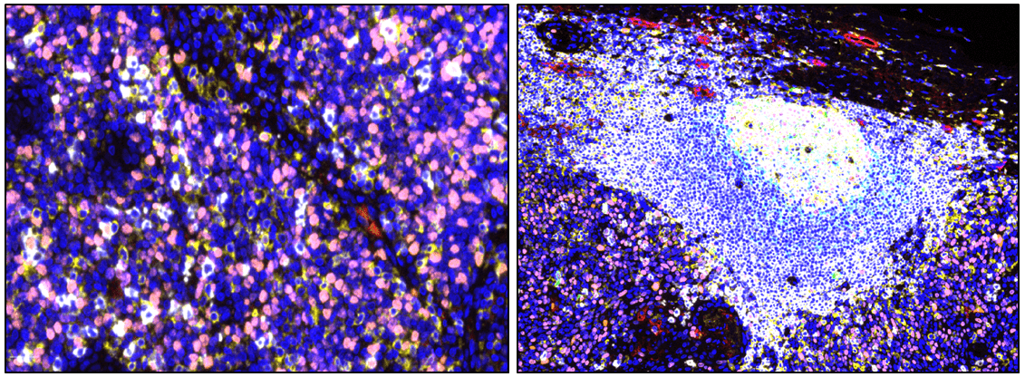 Immune Cell Neighborhoods in Tumors