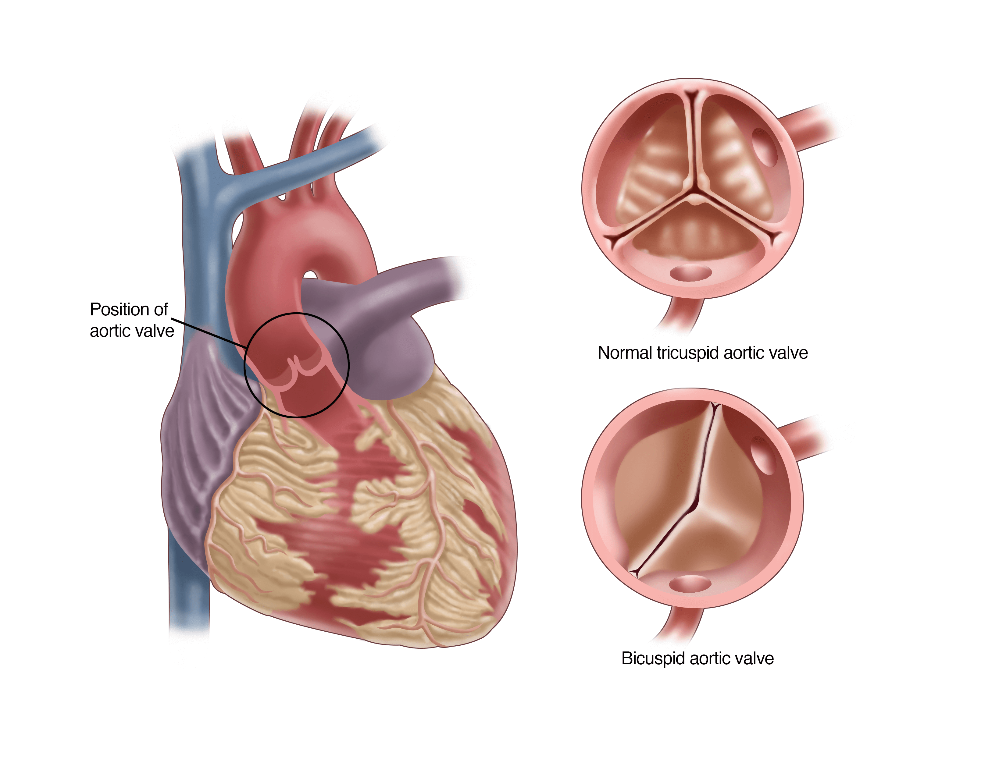 Bicuspid Aortic Valve Symptoms Treatment UPMC Heart Vascular Bicuspid Aortic Valve Symptoms Treatment UPMC Heart Vascular