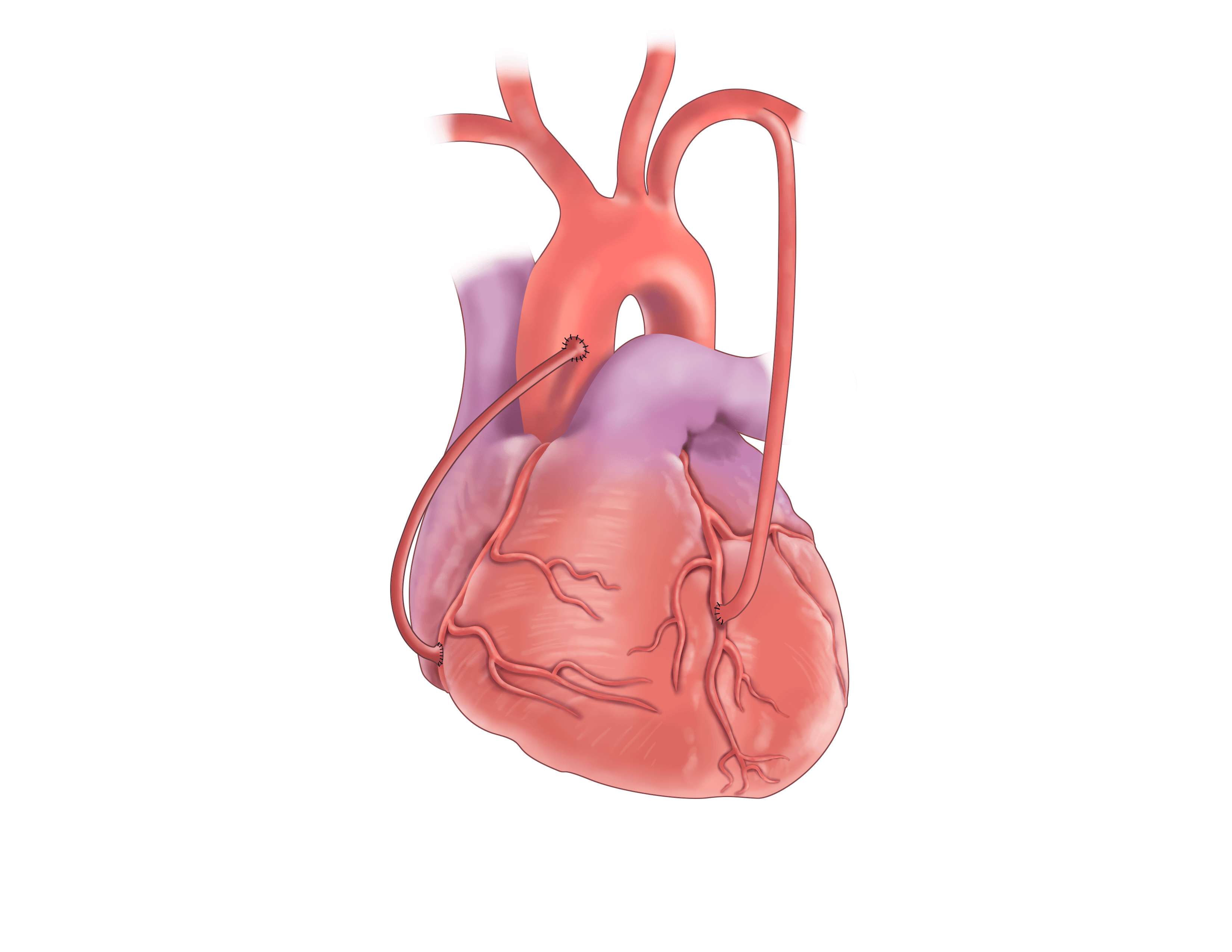 coronary artery bypass graft