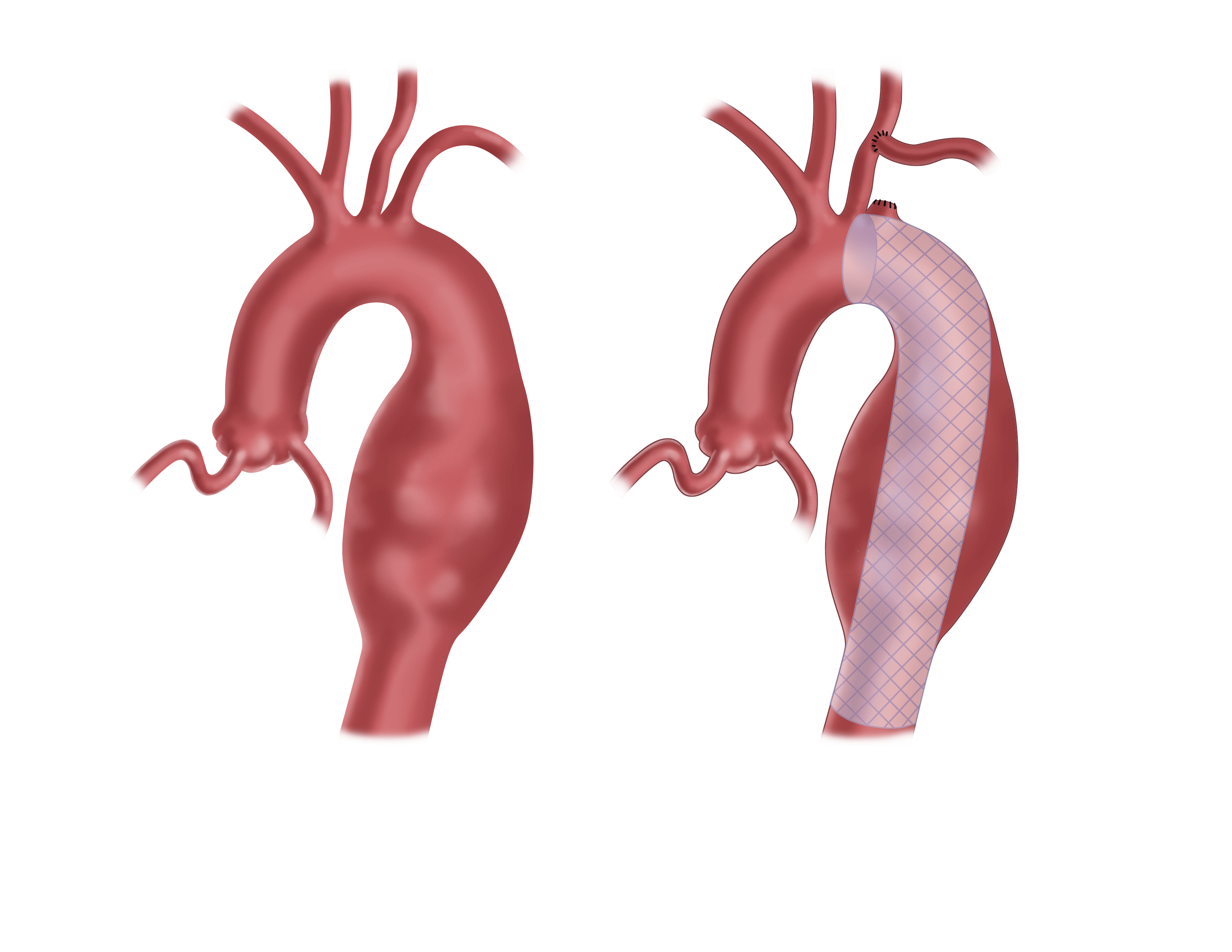 Minimally Invasive Aortic Aneurysm Repair | UPMC Heart & Vascular