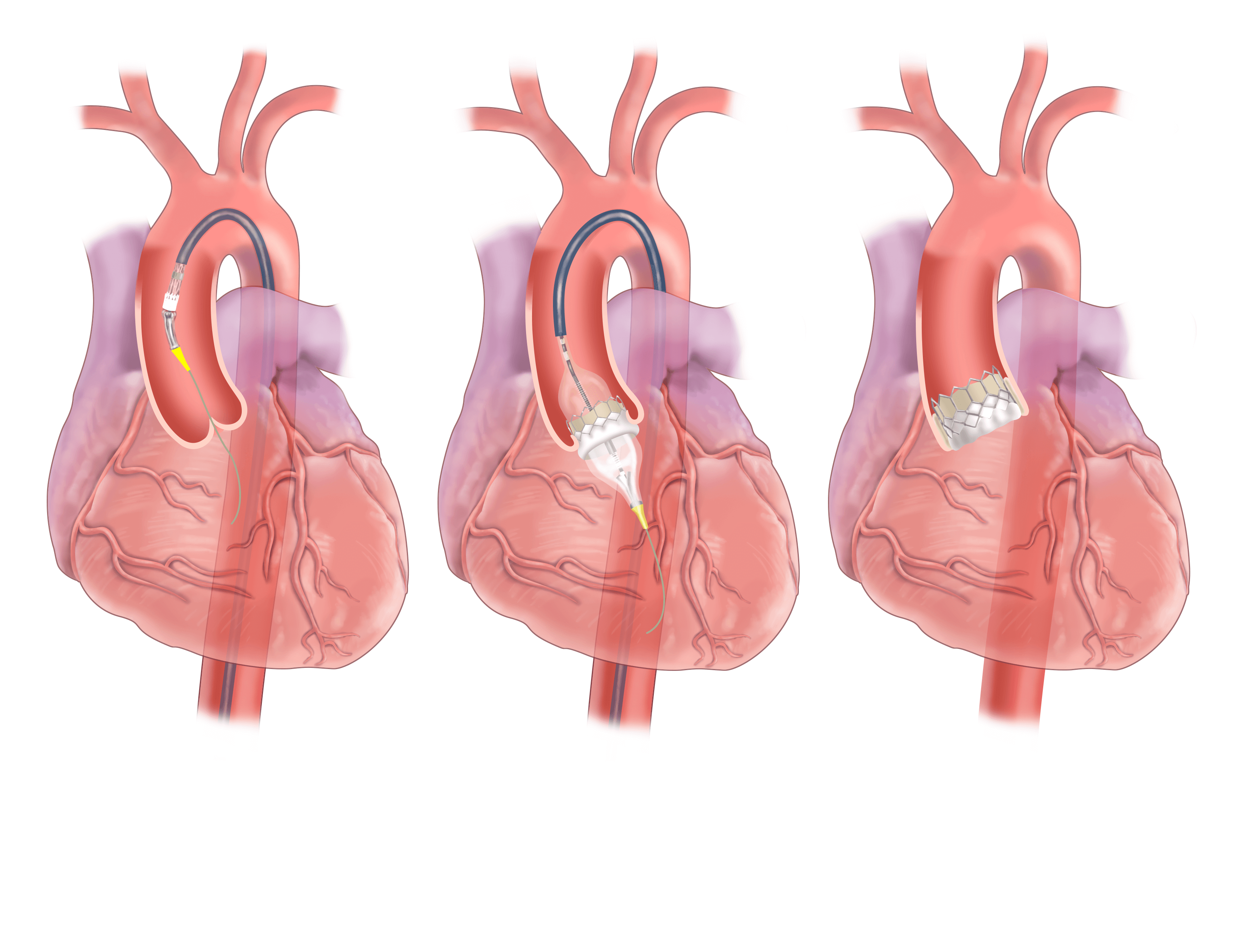 Aortic Valve Replacement   Transcatheter Aortic Valve Replacement 