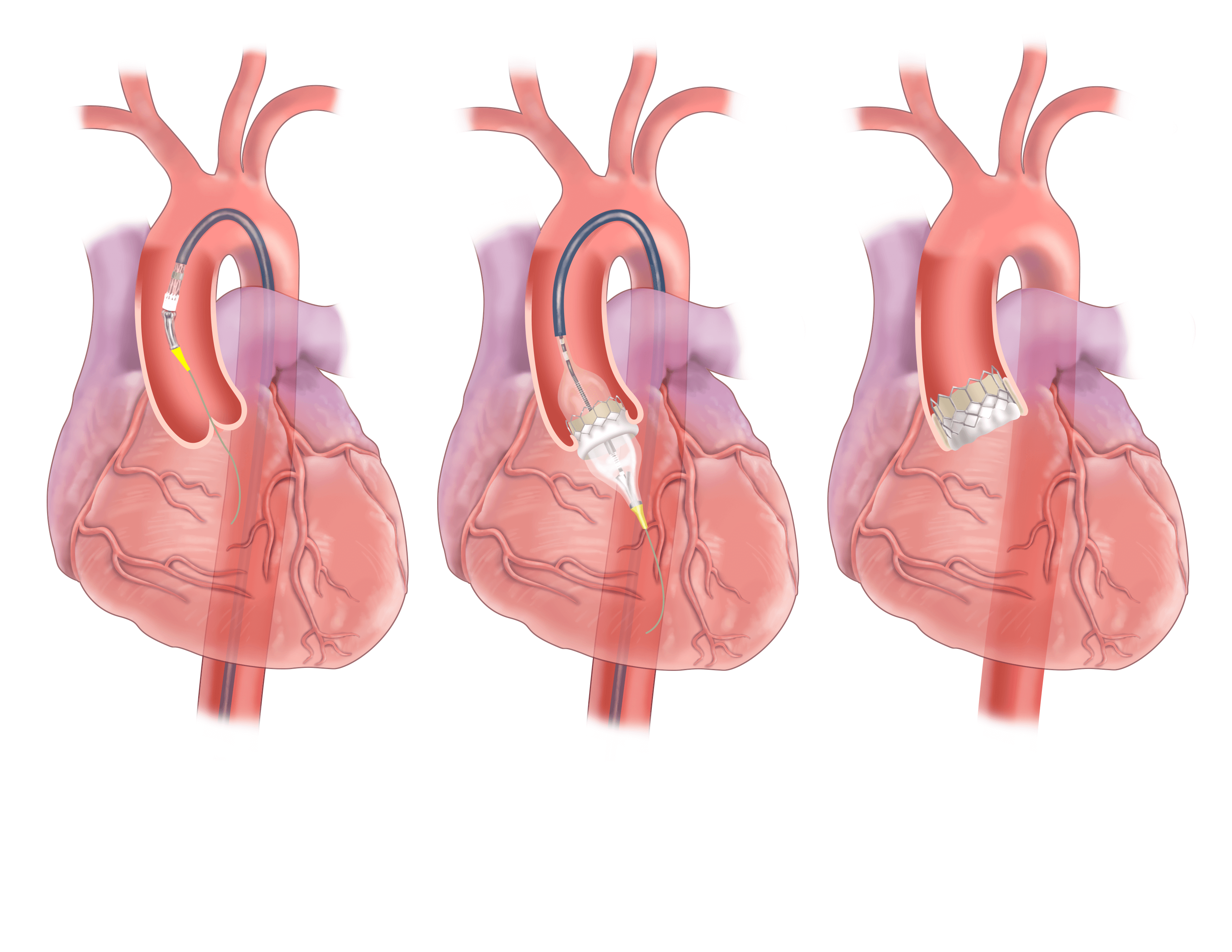 Tavr Procedure Tests And Procedures Upmc Heart And Vascular Institute