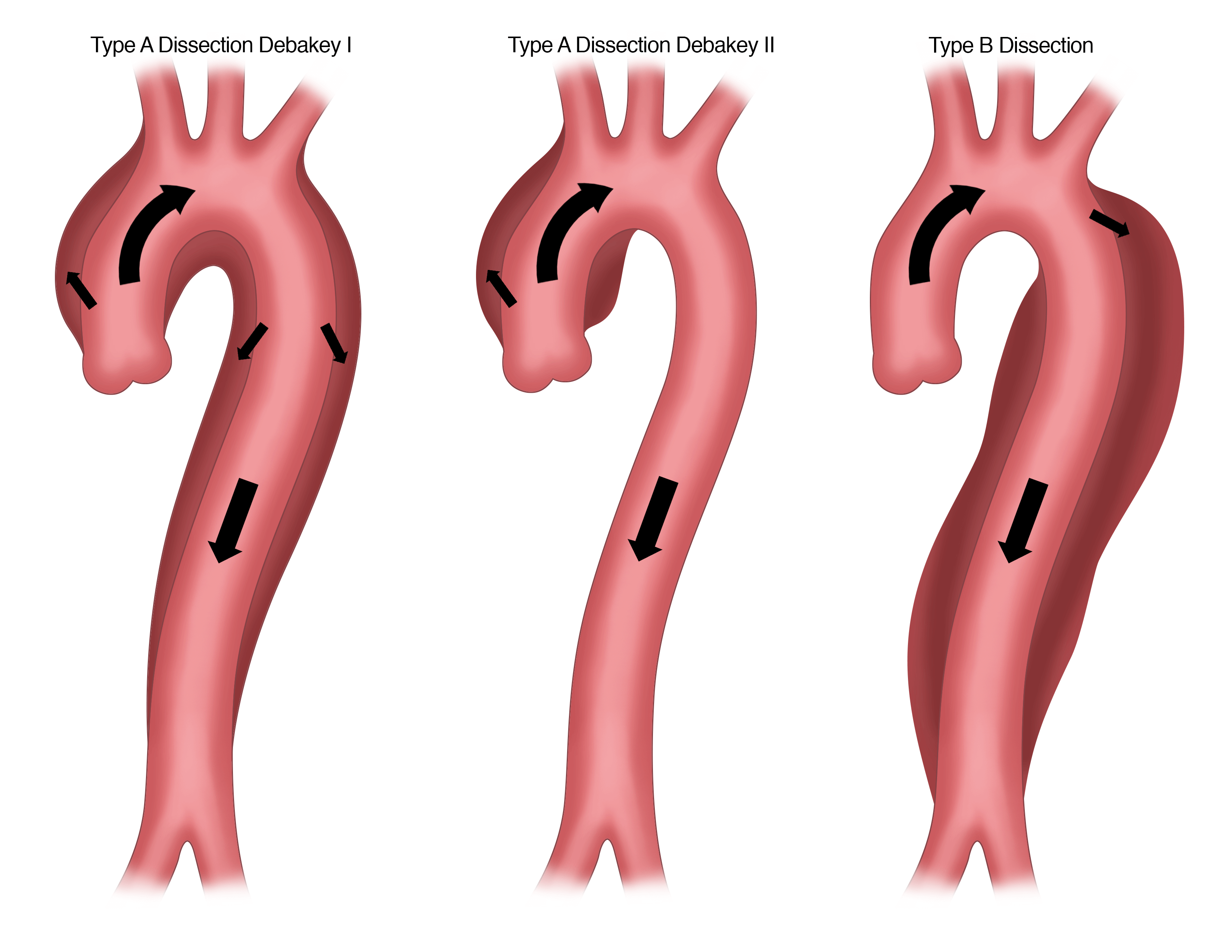 aortic dissection