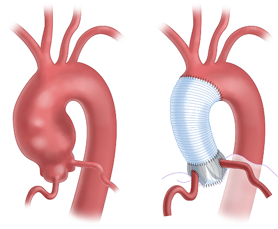 An aortic root replacement procedure replaces a section of the aorta with an artificial tube, or graft. The aortic valve is also removed and replaced with a mechanical or biological valve. 
