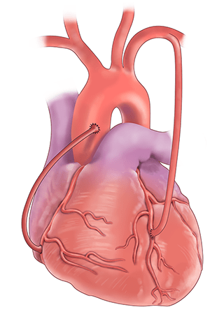 Coronary artery bypass graft is a surgical procedure in which a healthy vein or artery is taken from your leg or arm and used to create a new path for blood flow to your heart. These new paths bypass the blockage and restore proper blood flow to your heart. 