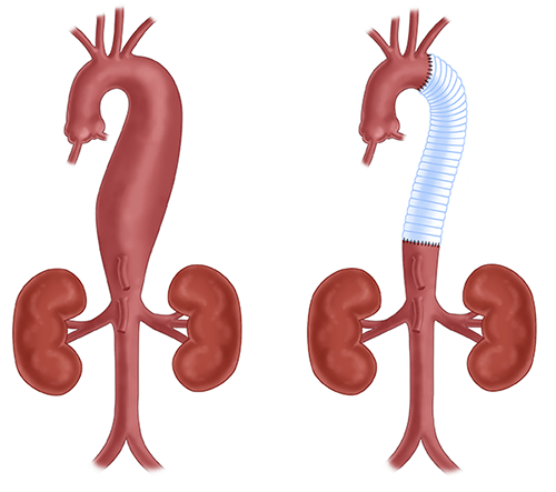 A thoracoabdominal aortic aneurysm (TAAA) is an enlargement in the aorta, occuring in the descending aorta, and located in the chest and abdomen. Extent I TAAA repairs use a synthetic graft to replace the majority of the descending thoracic aorta and the upper abdominal aorta. 