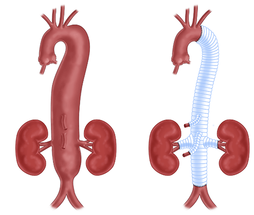 A thoracoabdominal aortic aneurysm (TAAA) is an enlargement in the aorta, occuring in the descending aorta, and located in the chest and abdomen. Extent II TAAA repair uses a synthetic graft to replace the entire length of the thoracoabdominal aorta. 
