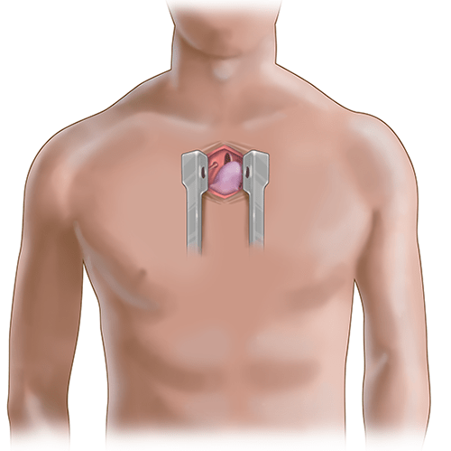 A mini sternotomy is a minimally invasive incision, measuring about 3 to 4 inches, that gives surgeons access to the heart. This often results in a shorter recovery time and a reduced risk of infection. 