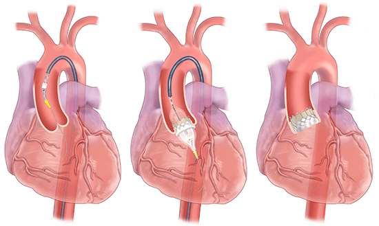 Transcatheter aortic valve replacement is a less invasive approach for replacing a diseased aortic valve. This is performed through catheters placed in blood vessels in the groin, chest, or neck. 