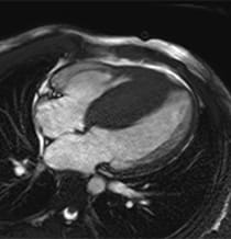 Image of Hypertrophic Cardiomyopathy Heart.