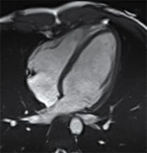 Image of normal heart.