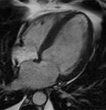 Dilated Cardiomyopathy Heart