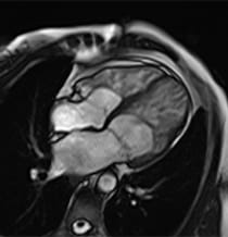 Image of LVNC Heart.