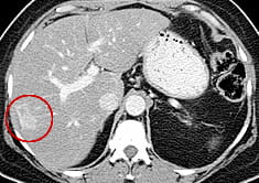 Pre-op CT scan: Tumor